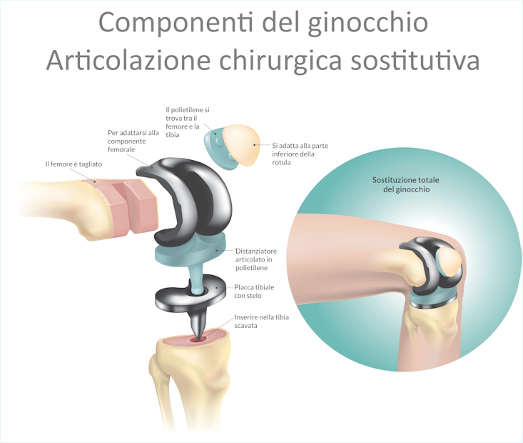 Artrosi di ginocchio e anca